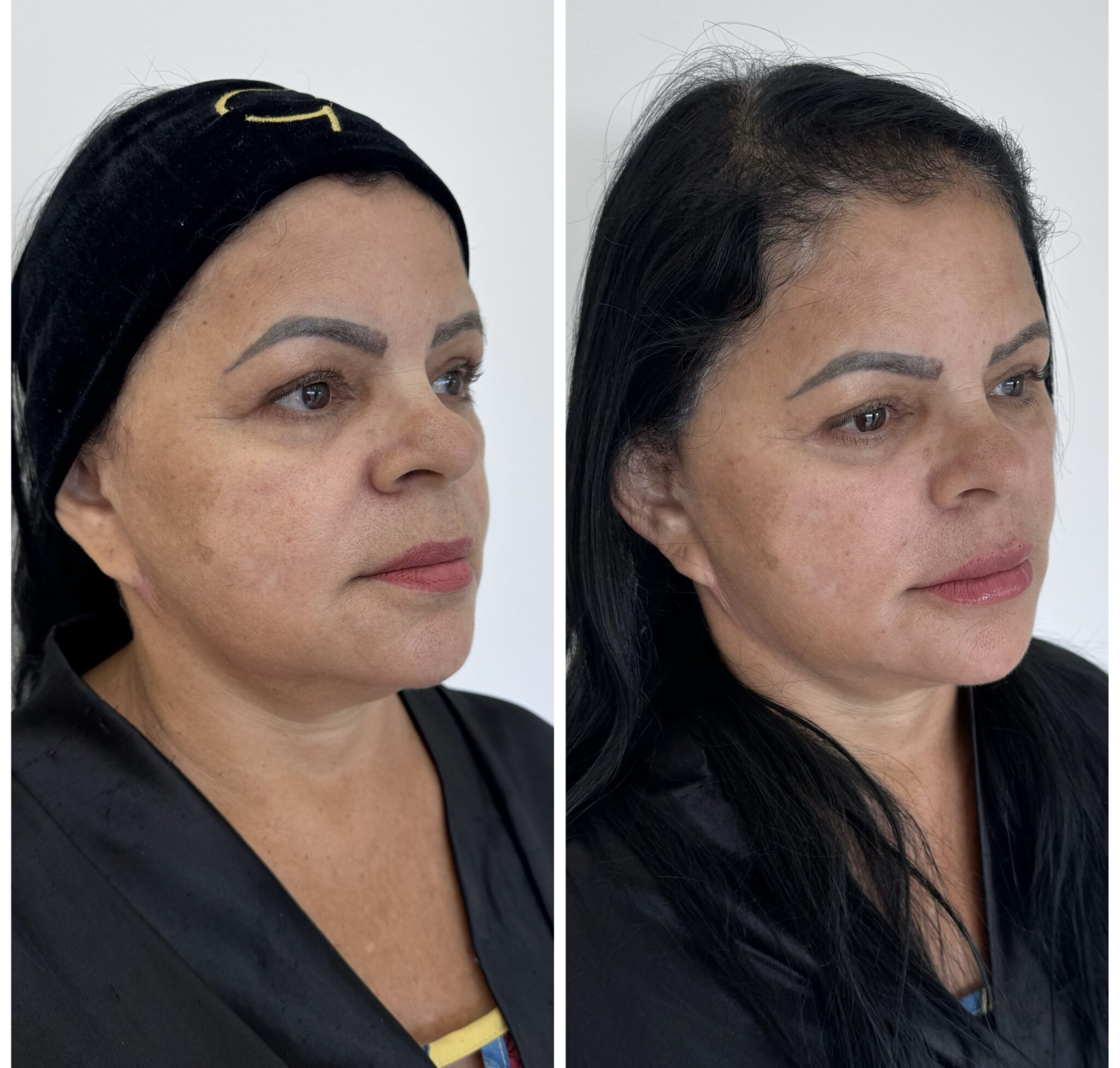 procedimento harmonização facial tríade m clínica agamenon alphaville
