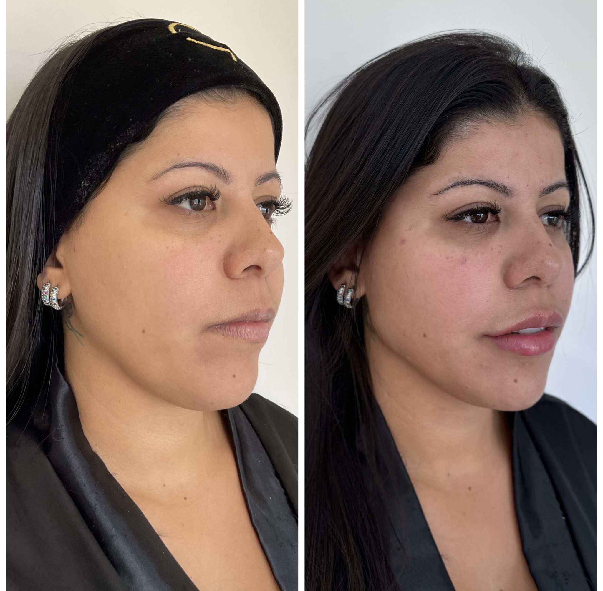procedimento harmonização facial tríade m clínica agamenon